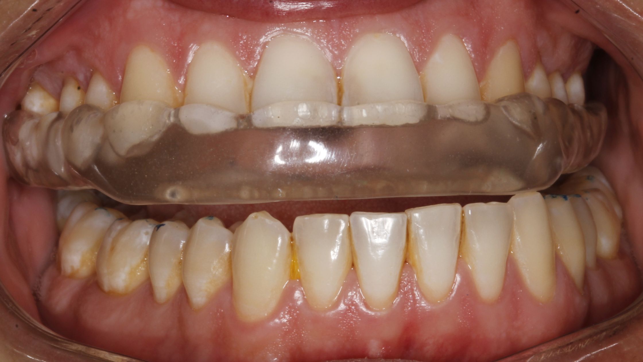 How to Stop Grinding Your Teeth (A Guide to Grinding Splints)