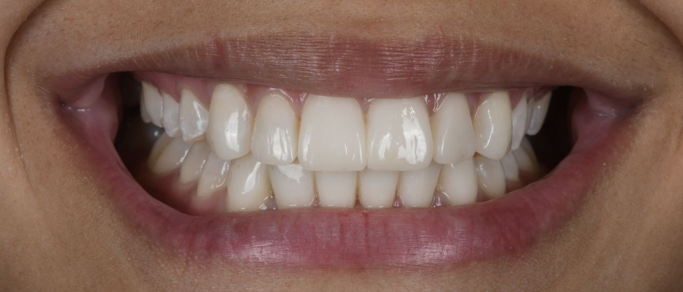 FlowSculpt Veneers A Modern, Minimally-Invasive Smile Upgrade