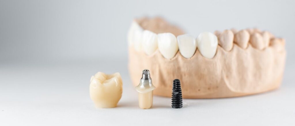 5 Things You Should Know When Considering Dental Implants