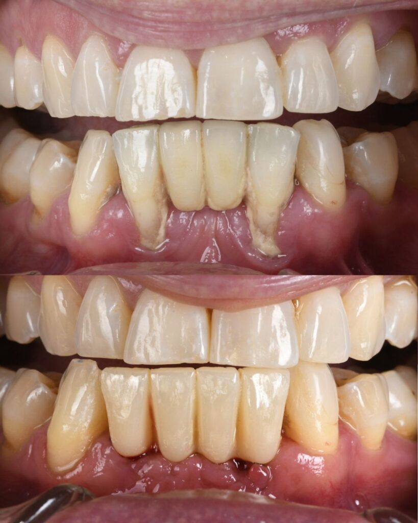 Before After Case Share Failing Bridge Implant 1