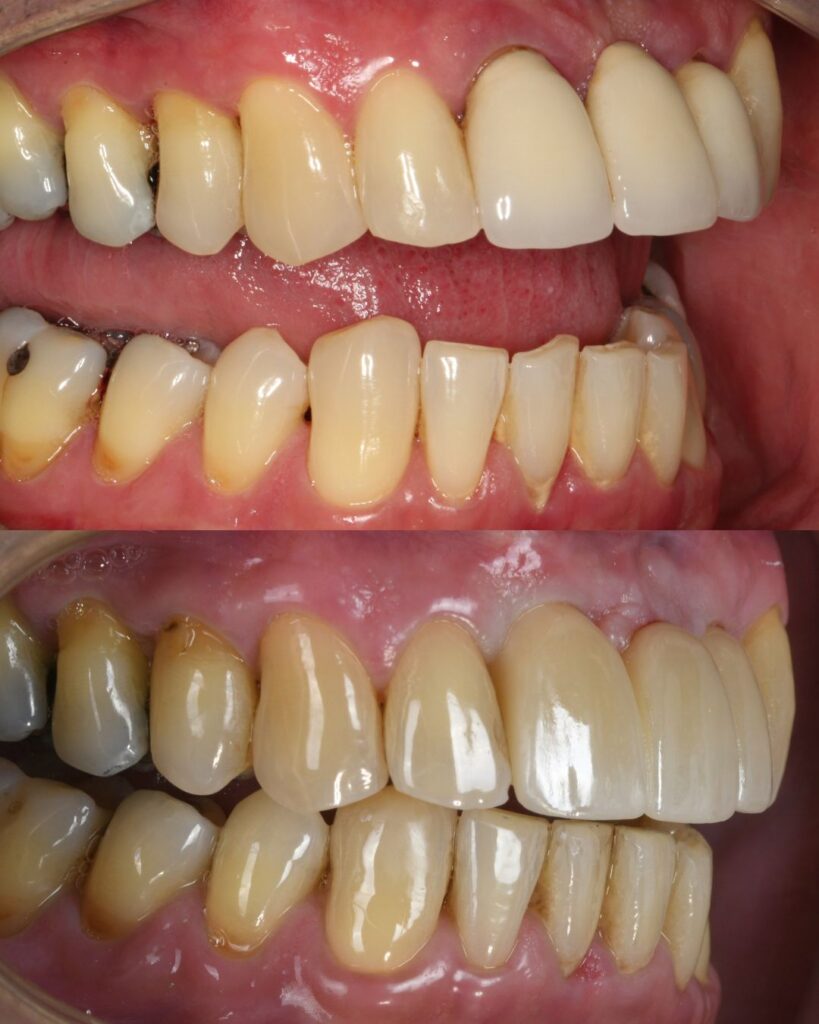 Before After Case Share Failing Bridge Implant 2