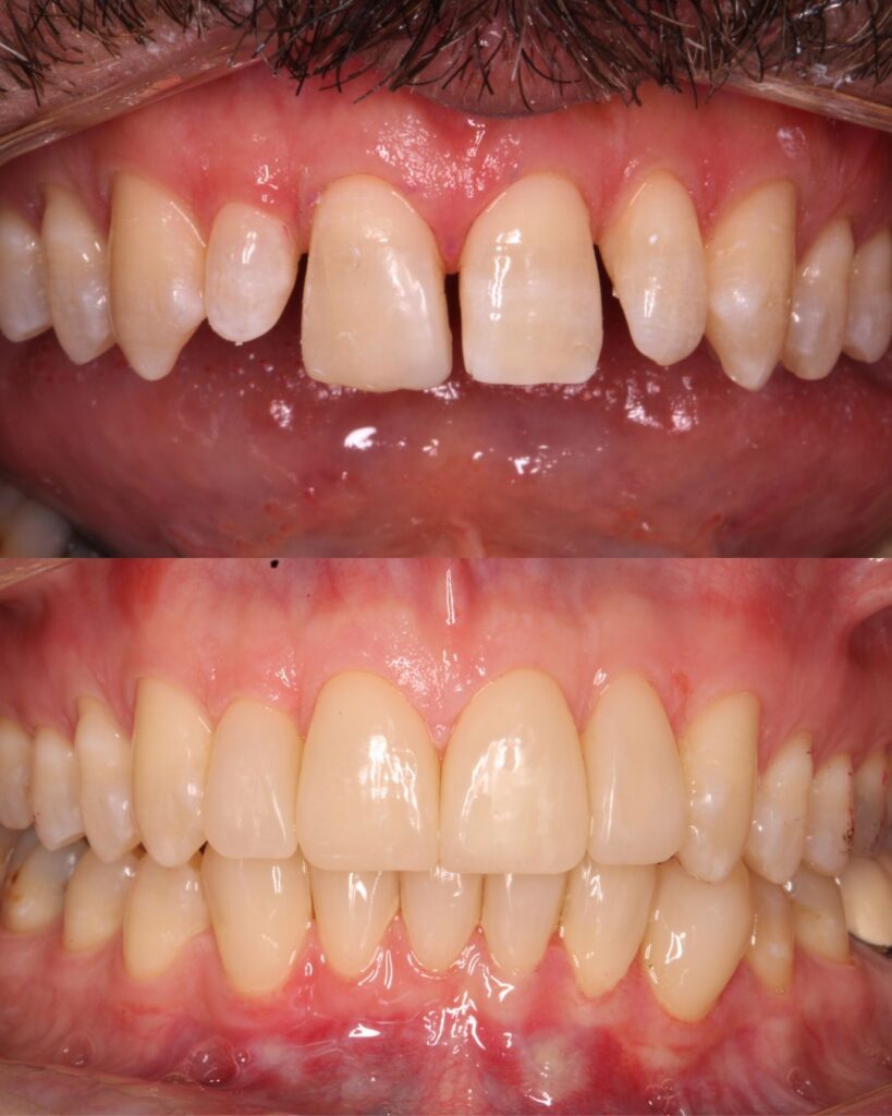 veneers before and after