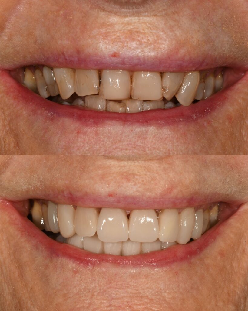 veneers before and after