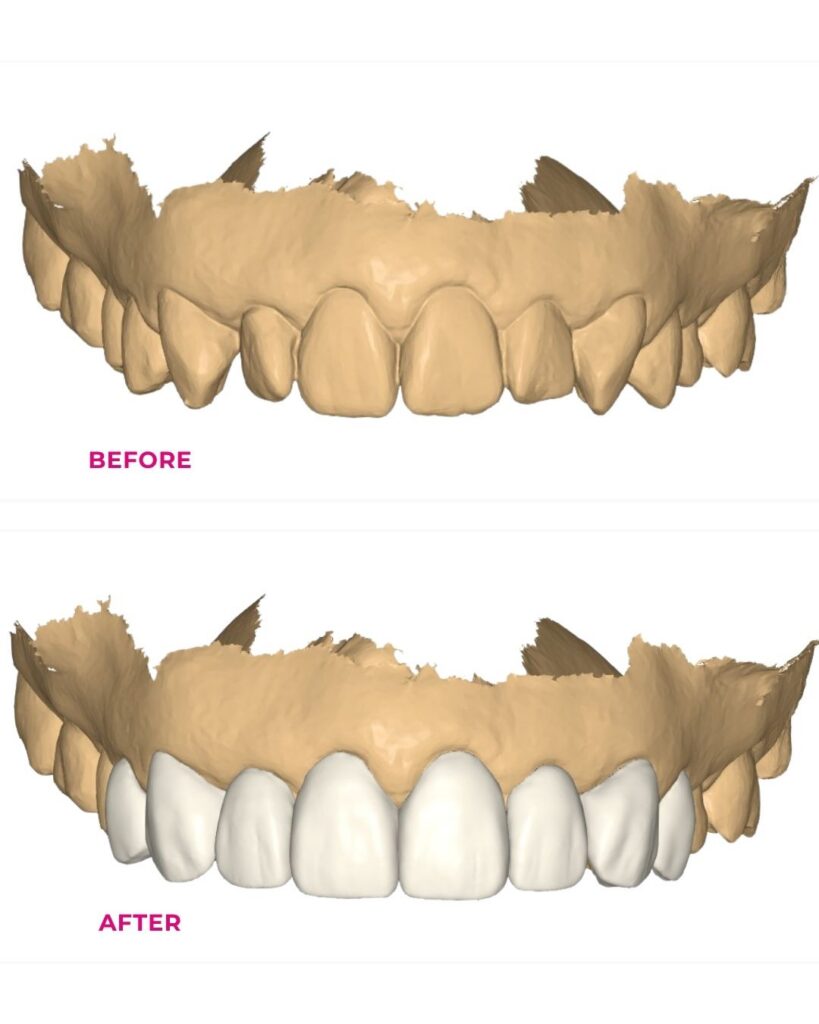 Smile designed in the digital world before and after