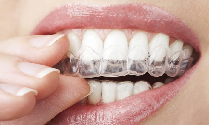 Example of At-Home Teeth Whitening